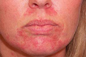Фото дерматита на лице у женщины