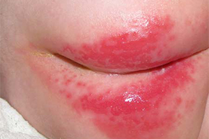 Фото Перианального дерматита у ребенка