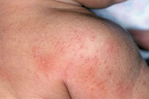 Аллергический дерматит у ребенка на плече