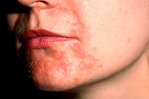 Атопический дерматит на лице. Фото 6