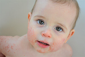 Атопический дерматит на лице у ребенка.
