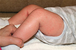 Атопический дерматит на ногах у ребенка. Фото 7