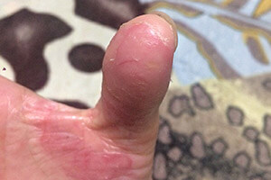 Экзематозный дерматит на пальцах рук