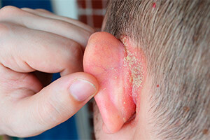 Экзематозный дерматит за ушами