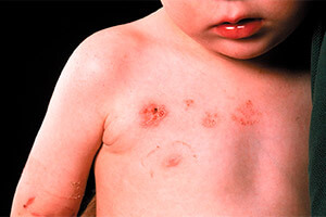 Экзематозный дерматит на теле у ребенка