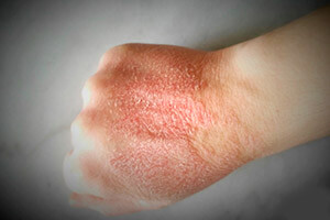 Холодовый дерматит на руках ребенка