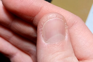 Холодовый дерматит на пальцах