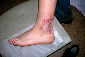 Хронический дерматит на ногах