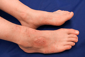 Хронический дерматит на ногах