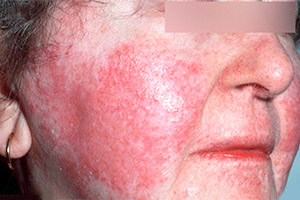 Хронический дерматит на лице