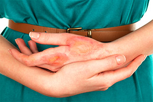 Хронический дерматит на руках