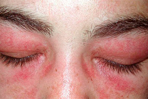 Хронический дерматит на глазах