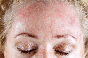 Себорейный дерматит на лице у женщины
