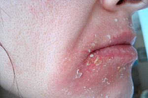 Себорейный дерматит на лице (в области рта)
