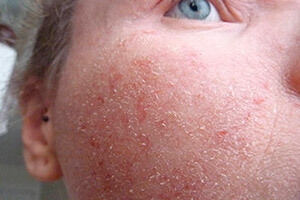 Себорейный дерматит на лице у ребенка