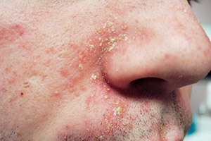 Себорейный дерматит на лице у мужчины