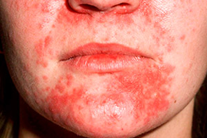 Буллезный дерматит на лице