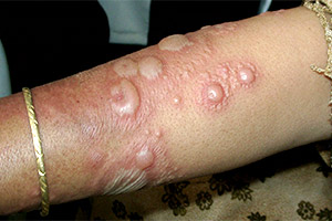 Буллезный дерматит на руках