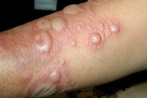Буллезный дерматит на руках