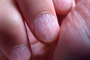 Грибок ногтей на руках у взрослого человека
