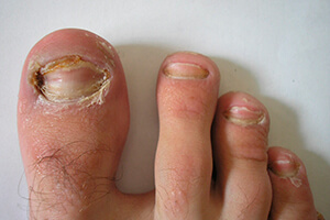 Грибок ногтей на ногах у человека