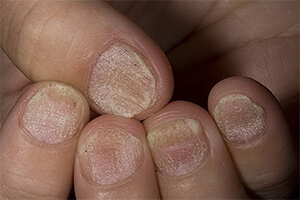 Причины возникновение псориаза на ногтях рук
