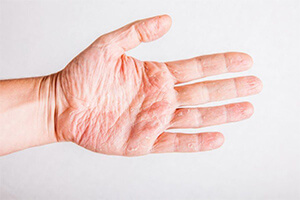 Причины возникновение псориаза на руках