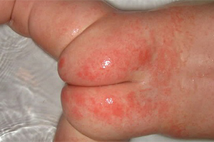 Фото пеленочного дерматита у ребенка