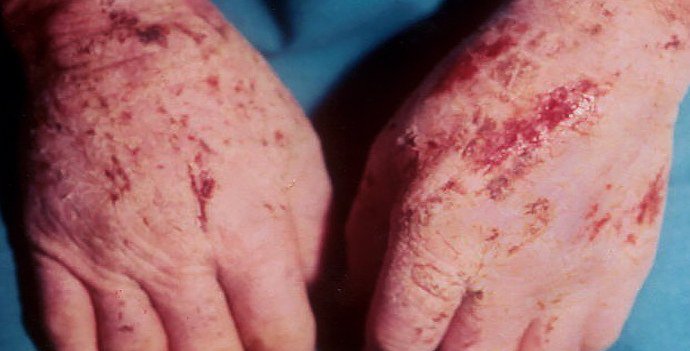 актинический дерматит на руках