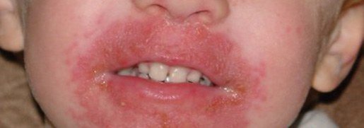 аллергия на губах у детей