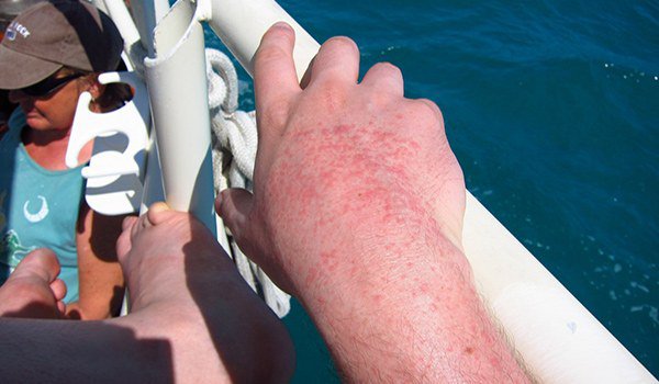 аллергия на солнце в области рук
