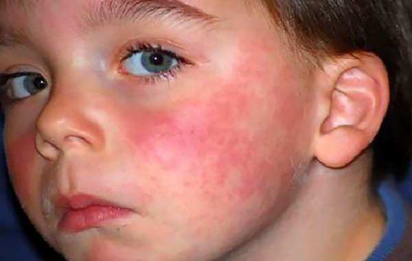 аллергия на солнце у детей