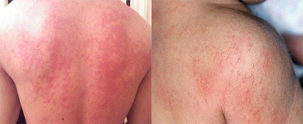 аллергия на спине признаки