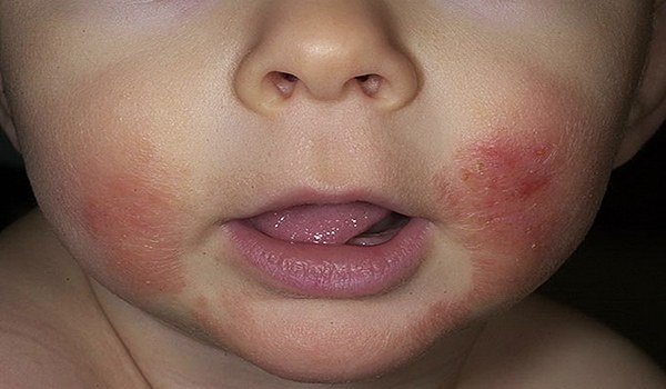 атопический дерматит у ребенка