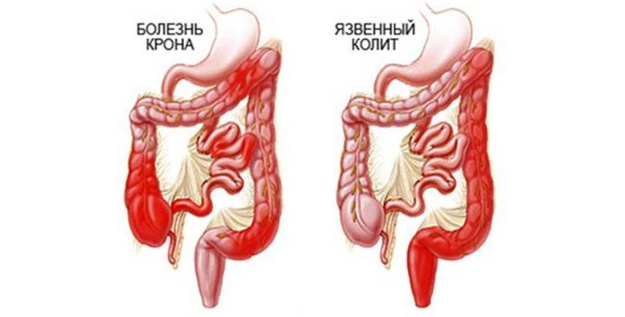 Болезнь крона и язвенный колит