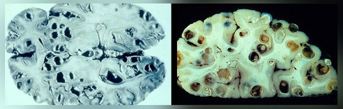 Цистицеркоз головного мозга