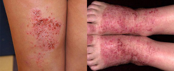 экзематозный дерматит на ногах