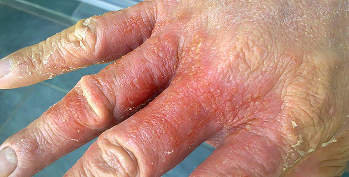 экзематозный дерматит на руках