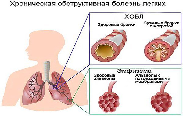 нарушение легочной функции