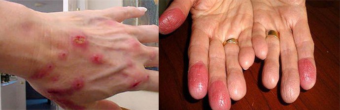 контактный дерматит на руках