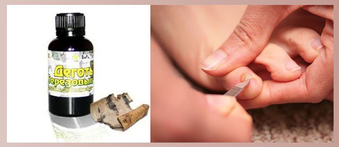 Лечение грибка ногтей березовым дегтем