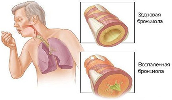 пример воспаленной бронхиолы