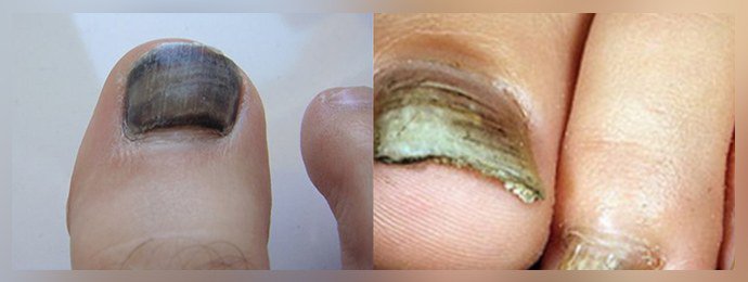Почернение ногтя при грибке