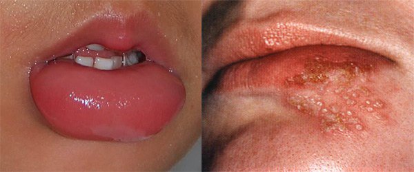 признаки аллергии на губах