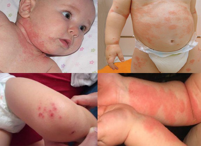 проявление аллергического дерматита у детей