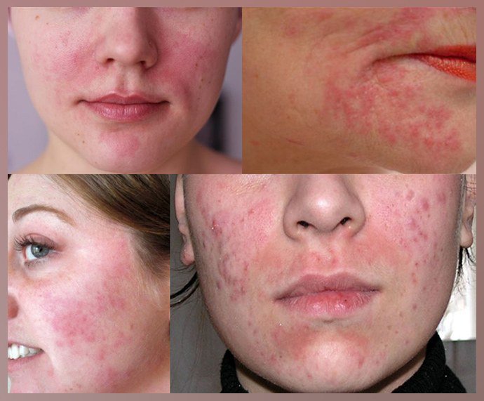 Проявление аллергии на лице