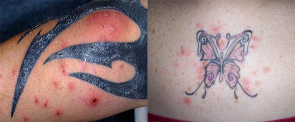 покраснение кожи и сыпь при аллергия на тату