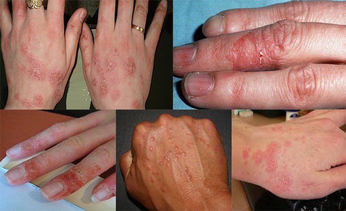 проявление дерматита на руках