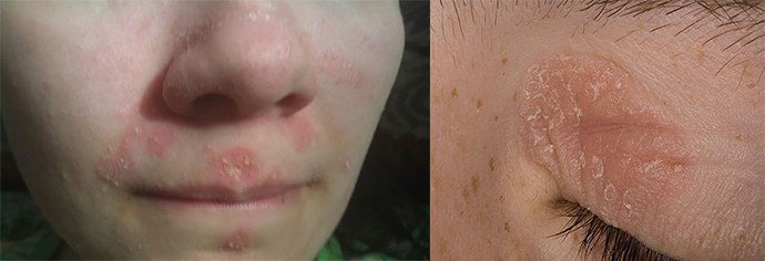 начальная стадия псориаза на лице