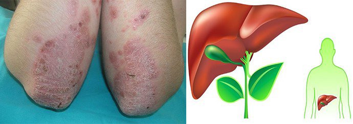 дезинтоксикация организма при псориазе